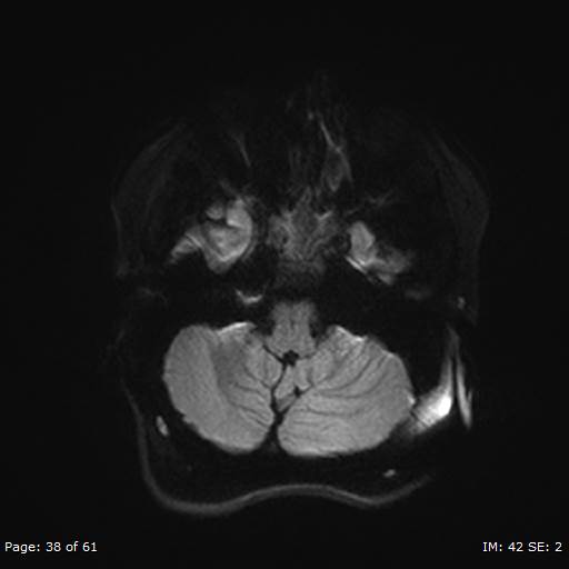 Balo concentric sclerosis (Radiopaedia 61637-69636 Axial DWI 38).jpg