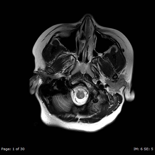 File:Balo concentric sclerosis (Radiopaedia 61637-69636 Axial T2 1).jpg