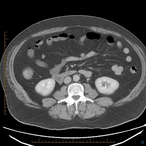File:Bariatric balloon causing gastric outlet obstruction (Radiopaedia 54449-60672 A 22).jpg
