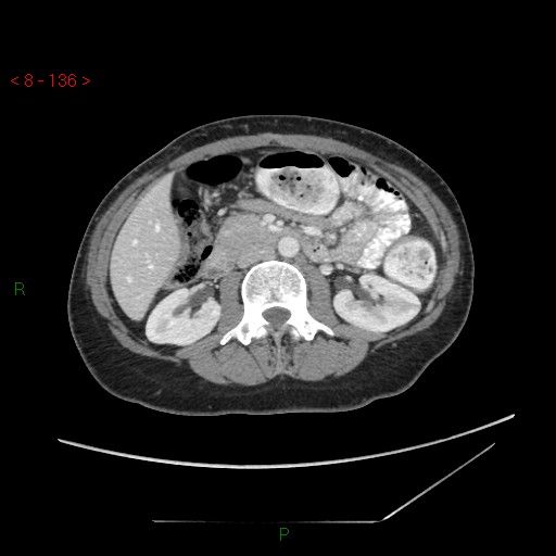 Bartholin gland cyst (Radiopaedia 54904-61181 A 34).jpg