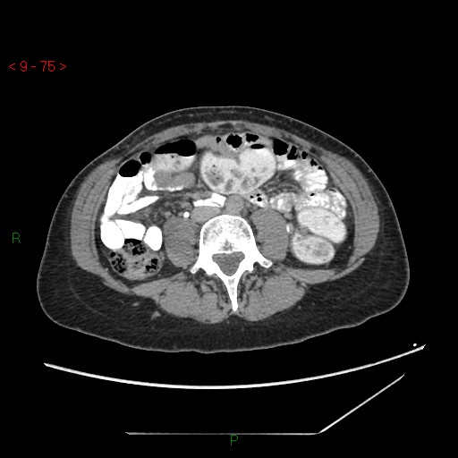 File:Bartholin gland cyst (Radiopaedia 54904-61181 Axial C+ delayed 19).jpg
