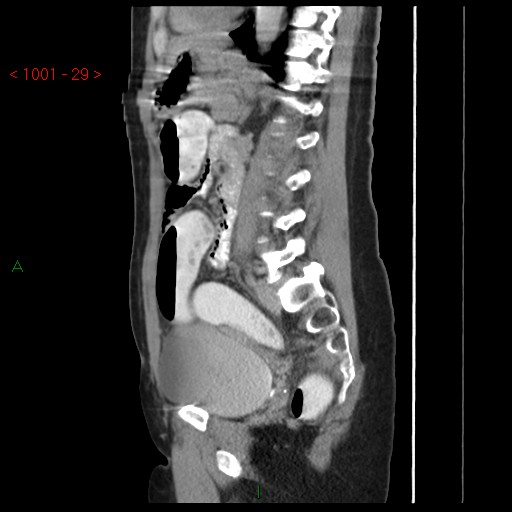 File:Bartholin gland cyst (Radiopaedia 54904-61181 Sagittal C+ delayed 29).jpg