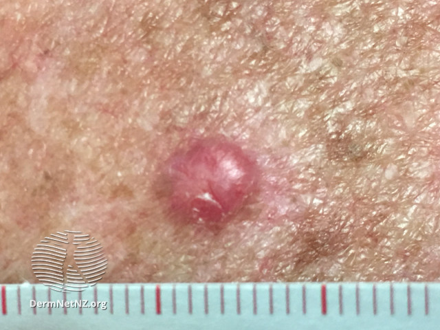 File:Basal cell carcinoma affecting the trunk (DermNet NZ 1202).jpg