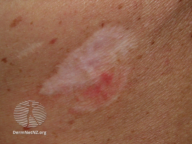 File:Basal cell carcinoma affecting the trunk (DermNet NZ lesions-bcc-trunk-0665).jpg