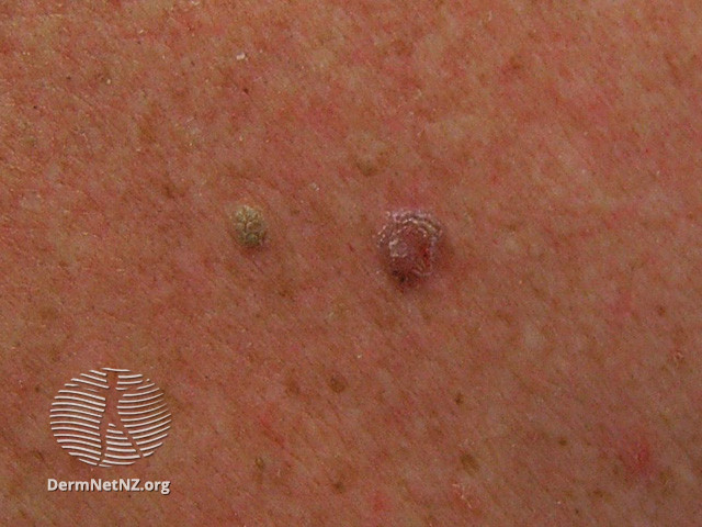 File:Basal cell carcinoma affecting the trunk (DermNet NZ lesions-bcc-trunk-0738).jpg