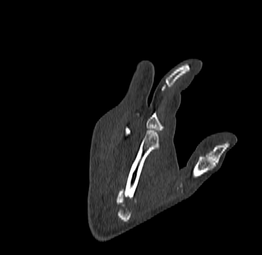 Base of 2nd metacarpal fracture (Radiopaedia 73741-84544 Coronal bone window 71).jpg