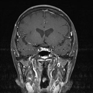 File:Base of skull chondrosarcoma (Radiopaedia 30410-31070 G 4).jpg