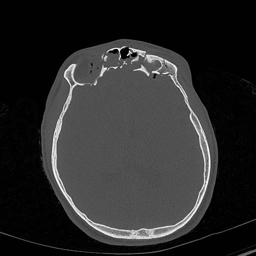 Base of skull fracture with bilateral Le Fort fractures (Radiopaedia 47094-51638 Axial bone window 51).jpg