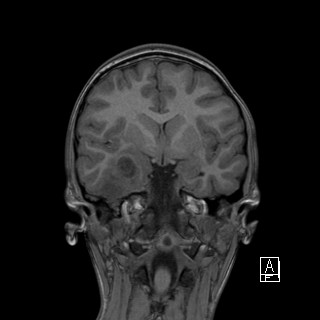 Base of skull rhabdomyosarcoma (Radiopaedia 32196-33142 Coronal T1 21).jpg