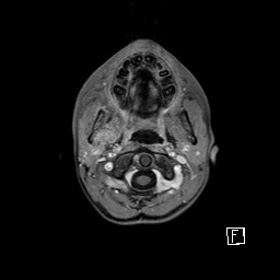 Base of skull rhabdomyosarcoma (Radiopaedia 32196-33142 T1 C+ fat sat 17).jpg