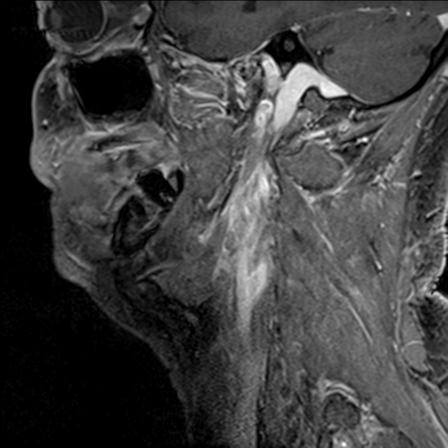 Base of tongue squamous cell carcinoma (Radiopaedia 31174-31884 F 128).jpg