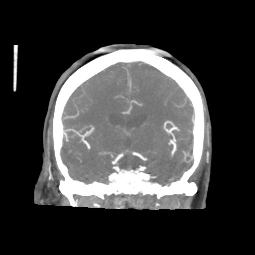 Basilar and bilateral vertebral artery occlusion (Radiopaedia 45592-49723 B 51).png