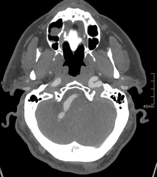 File:Basilar artery aneurysm (Radiopaedia 56261-62932 A 43).jpg
