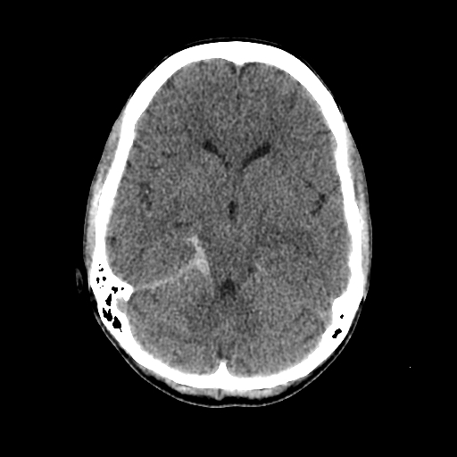File:Basilar artery perforator aneurysm (Radiopaedia 82455-96597 Axial non-contrast 15).jpg