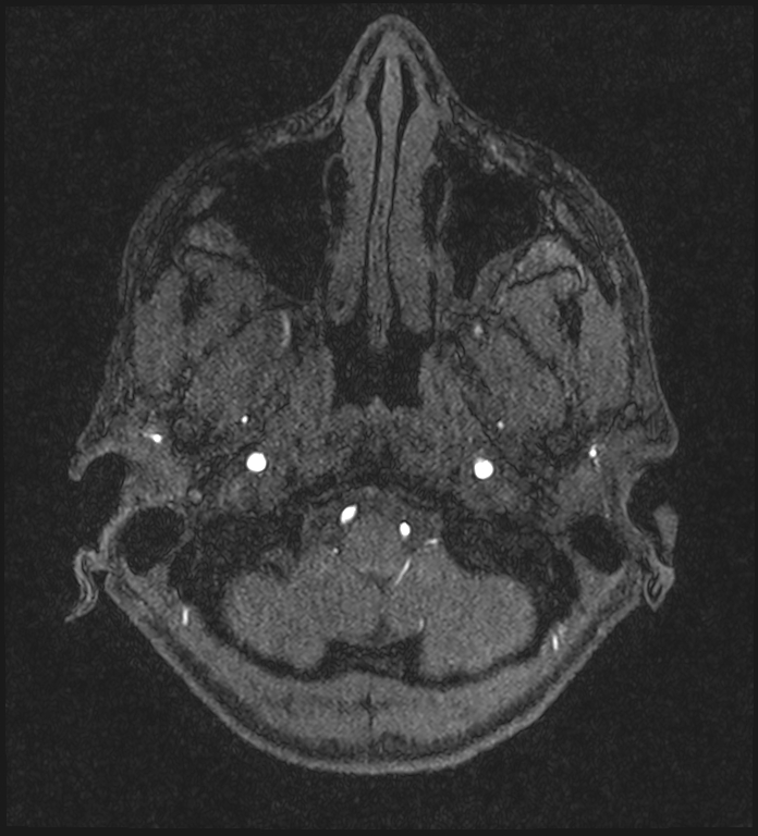 Basilar artery perforator aneurysm (Radiopaedia 82455-97733 Axial MRA 28).jpg