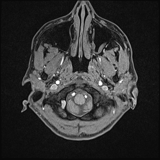File:Basilar artery perforator aneurysm (Radiopaedia 82455-97733 Axial T1 fat sat 6).jpg