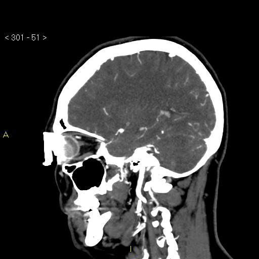 File:Basilar artery thrombosis (Radiopaedia 16260-15944 C 45).jpg