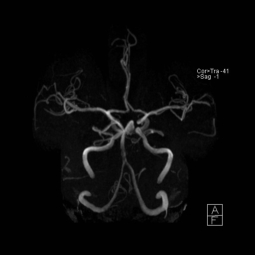 Basilar tip aneurysm (Radiopaedia 26504-26632 D 5).jpg