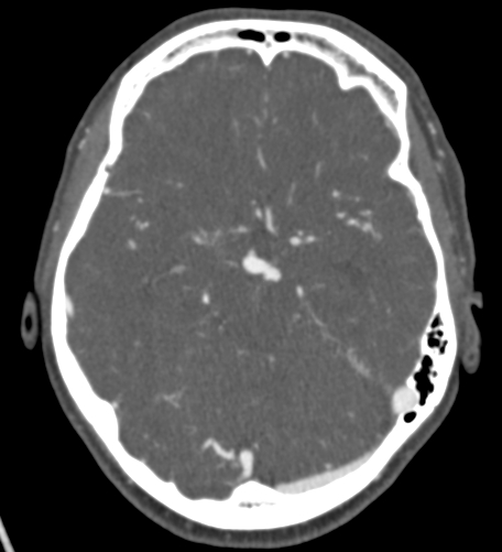 Basilar tip aneurysm with coiling (Radiopaedia 53912-60086 A 59).jpg
