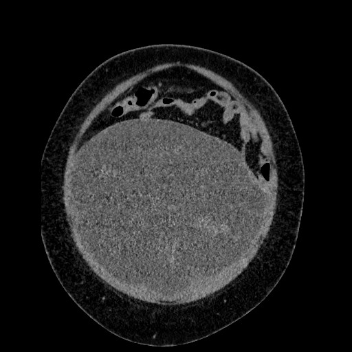 File:Benign leiomyoma with hydropic features (Radiopaedia 89250-106130 B 26).jpg