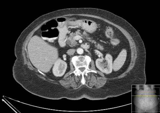 Bicameral celiacomesenteric aneurysm (Radiopaedia 55766-62327 A 24).jpg