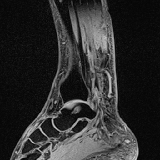 Bilateral Achilles tendon complete tear (Radiopaedia 81344-95051 Sagittal WE - Right 73).jpg