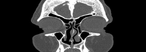 Bilateral Ectopic Infraorbital Nerves (Radiopaedia 49006-54084 Coronal bone window 7).jpg