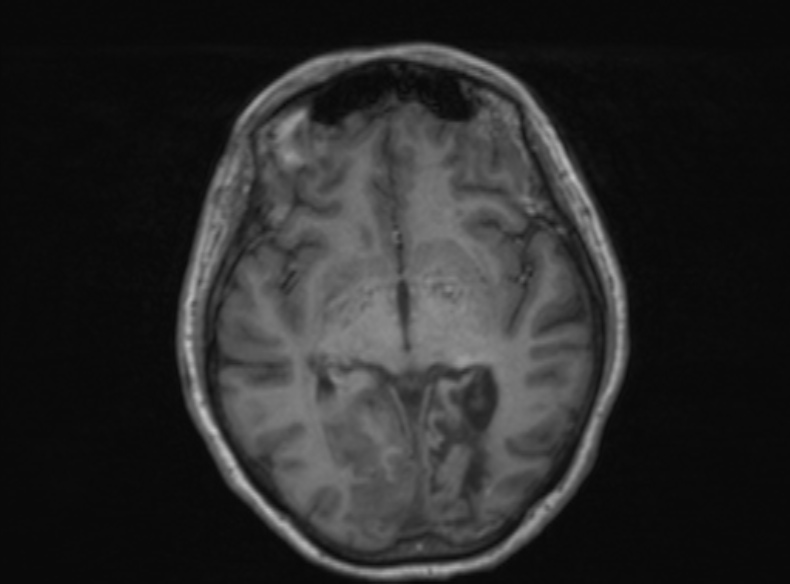 Bilateral PCA territory infarction - different ages (Radiopaedia 46200-51784 Axial T1 249).jpg