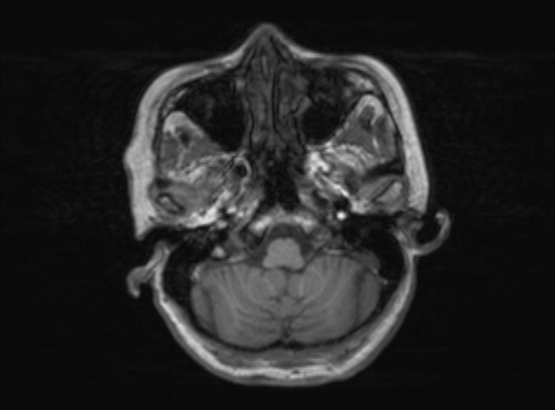 Bilateral PCA territory infarction - different ages (Radiopaedia 46200-51784 Axial T1 324).jpg