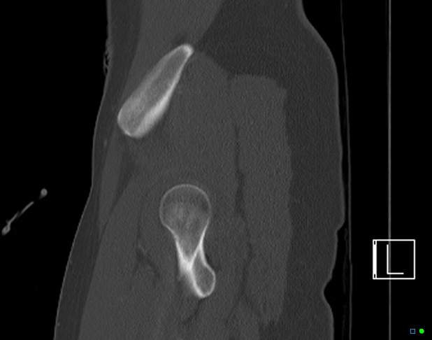 Bilateral acetabular fractures (Radiopaedia 79272-92308 Sagittal bone window 13).jpg