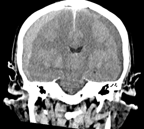 Bilateral acute on chronic subdural hematomas (Radiopaedia 78466-91146 Coronal non-contrast 38).jpg