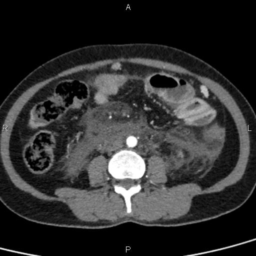 Bilateral adrenal gland hyperenhancement in pancreatitis (Radiopaedia 86642-102753 B 79).jpg