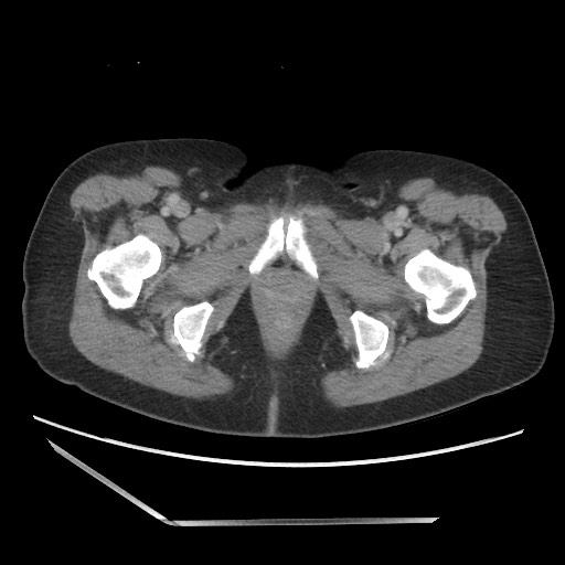 Bilateral adrenal granulocytic sarcomas (chloromas) (Radiopaedia 78375-91007 A 123).jpg