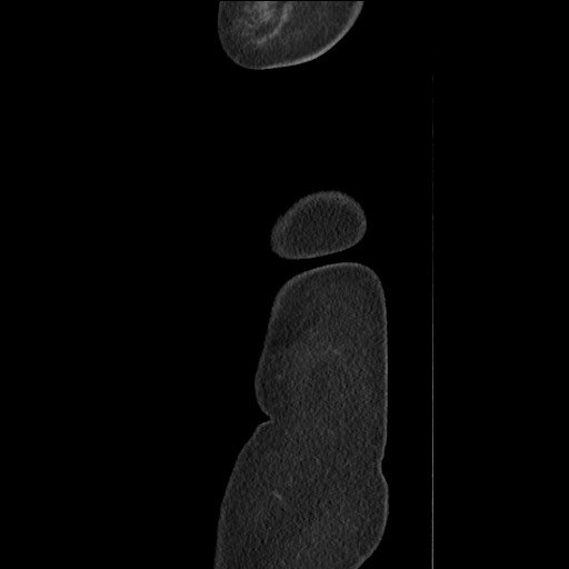 Bilateral adrenal granulocytic sarcomas (chloromas) (Radiopaedia 78375-91007 C 137).jpg