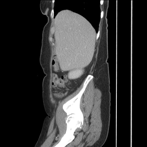 Bilateral adrenal granulocytic sarcomas (chloromas) (Radiopaedia 78375-91007 C 38).jpg