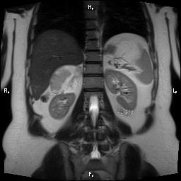 File:Bilateral adrenal myelolipoma (Radiopaedia 63058-71537 Coronal T2 9).jpg