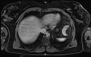 Bilateral adrenal myelolipoma (Radiopaedia 63058-71537 H 13).jpg
