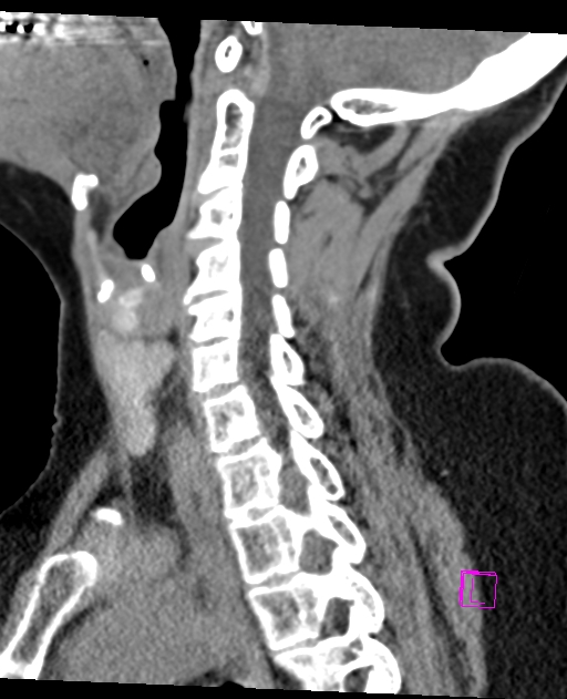 Bilateral atlanto-occipital assimilation (Radiopaedia 28350-28603 D 35).jpg