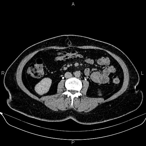 File:Bilateral benign adrenal adenomas (Radiopaedia 86912-103124 Axial C+ delayed 80).jpg