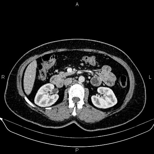 Bilateral benign adrenal adenomas (Radiopaedia 86912-103124 B 48).jpg