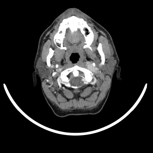 Bilateral carotid body tumors (Radiopaedia 52899-58827 A 42).jpg