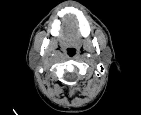 Bilateral carotid body tumors (Radiopaedia 61841-69870 Axial non-contrast 21).jpg