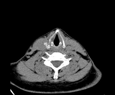 Bilateral carotid body tumors (Radiopaedia 61841-69870 Axial non-contrast 77).jpg
