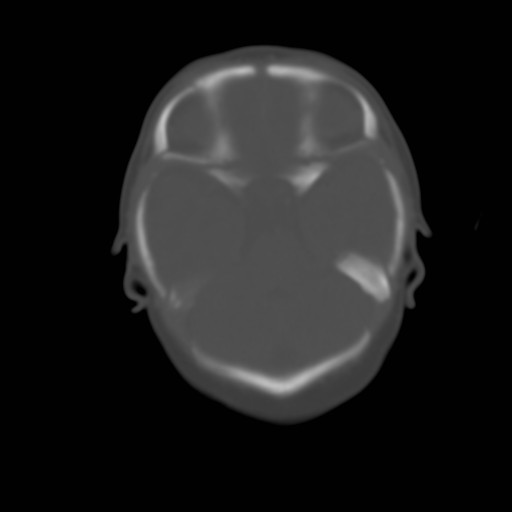 File:Bilateral cephalohematomas and subdural hematomas (Radiopaedia 26778-26929 Axial bone window 3).jpg