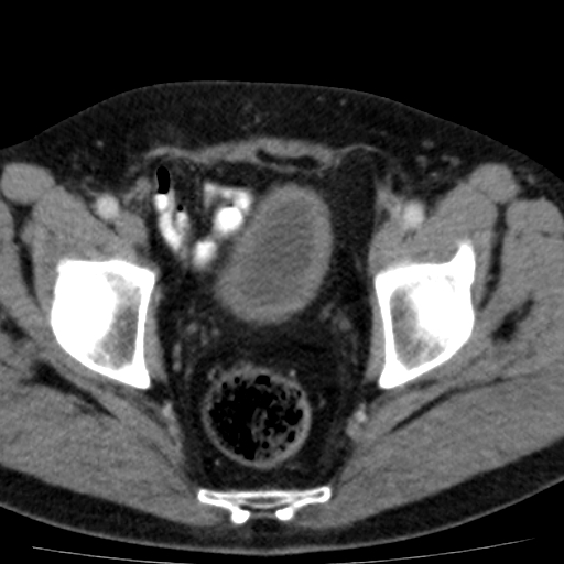 File:Bilateral direct inguinal herniae (Radiopaedia 17016-16719 B 14).jpg