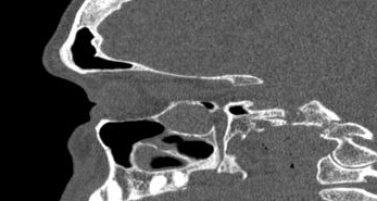 File:Bilateral ectopic infraorbital nerves (Radiopaedia 49006-54084 Sagittal 11).png