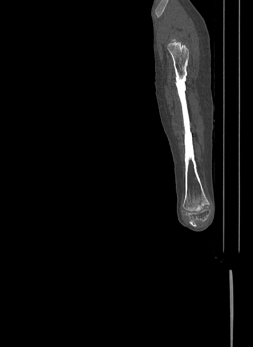 Bilateral fibular hemimelia type II (Radiopaedia 69581-79491 Sagittal bone window 70).jpg