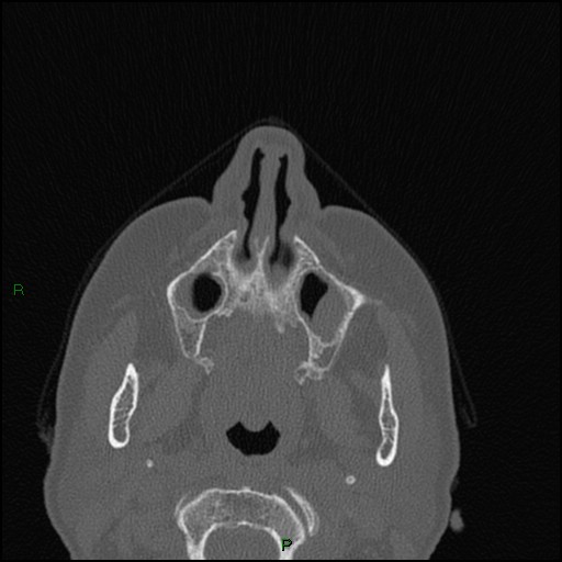 Bilateral frontal mucoceles (Radiopaedia 82352-96454 Axial bone window 226).jpg