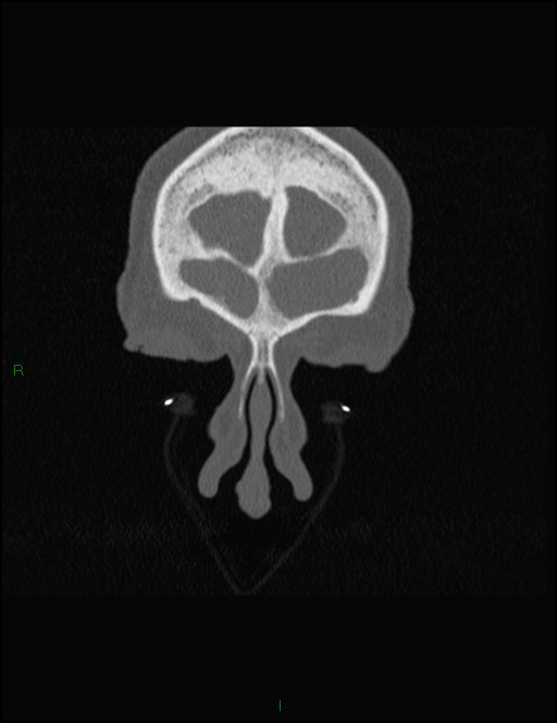 Bilateral frontal mucoceles (Radiopaedia 82352-96454 Coronal 50).jpg