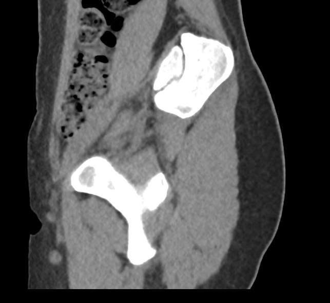 File:Bilateral mature cystic ovarian teratoma (Radiopaedia 88821-105592 D 4).jpg